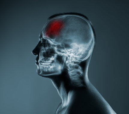 X-ray side view of a human head showing a highlighted red area on the brain, indicating a possible injury.