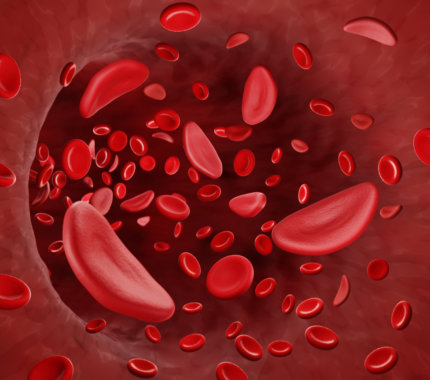 sickle cell